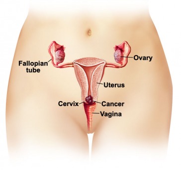 cervical cancer  survival rates